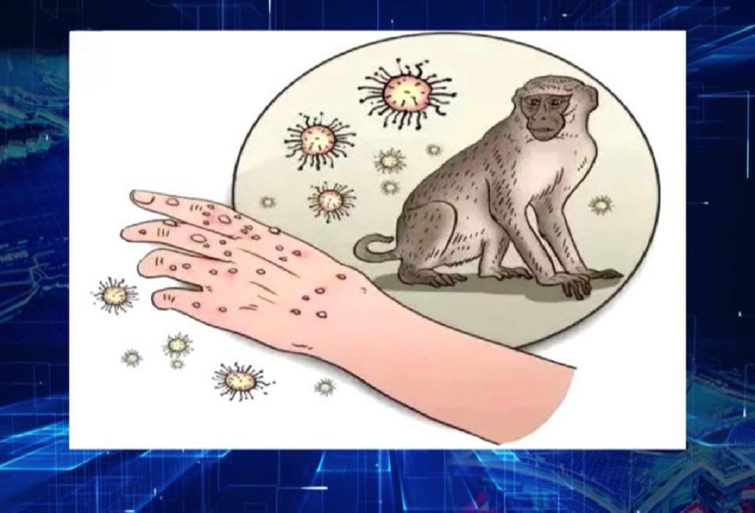 What You Need to Know about the Monkeypox Virus ？